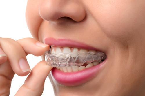 Woman putting in clear braces l LJ Dentistry Moline IL