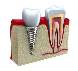 side view of dental implant I LJ dentistry in moline il