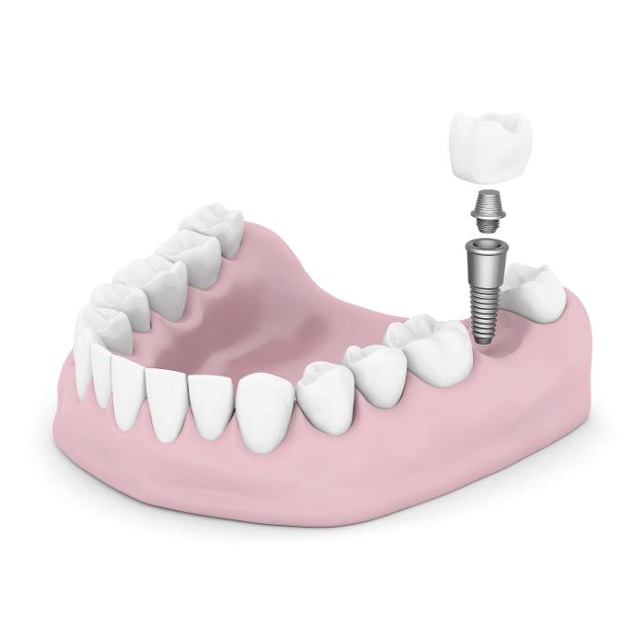 Graphic of dental crown and screw going into bottom teeth | Dental Implants Quad Cities IL