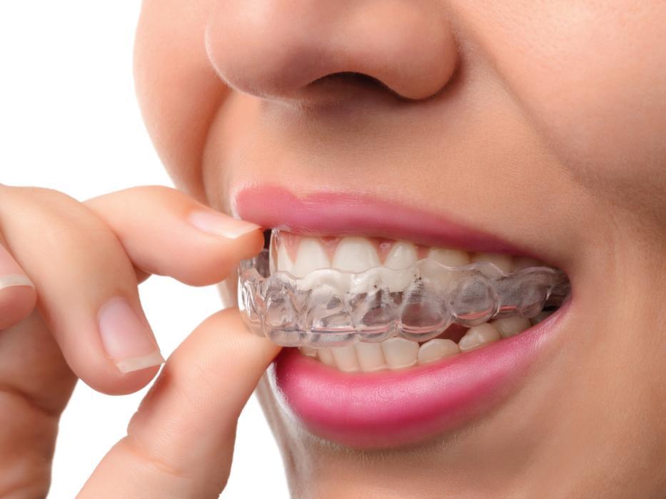 Woman putting on Invisalign clear braces | Invisalign Quad Cities 61265
