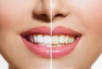Side by side comparison smile l Dentist Quad Cities