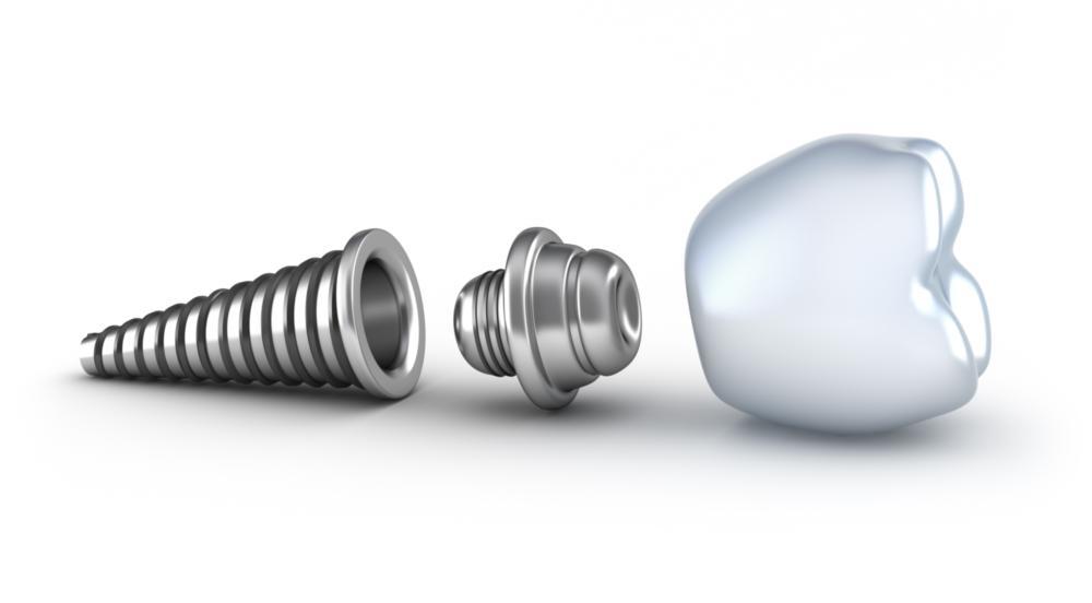 Three parts of a dental implant | Quad Cities Dentist 