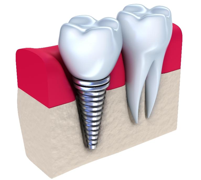 Dental Implants | LJ Dentistry | Moline, IL