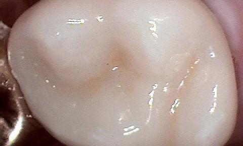 image of the same tooth after a CEREC crown Moline IL