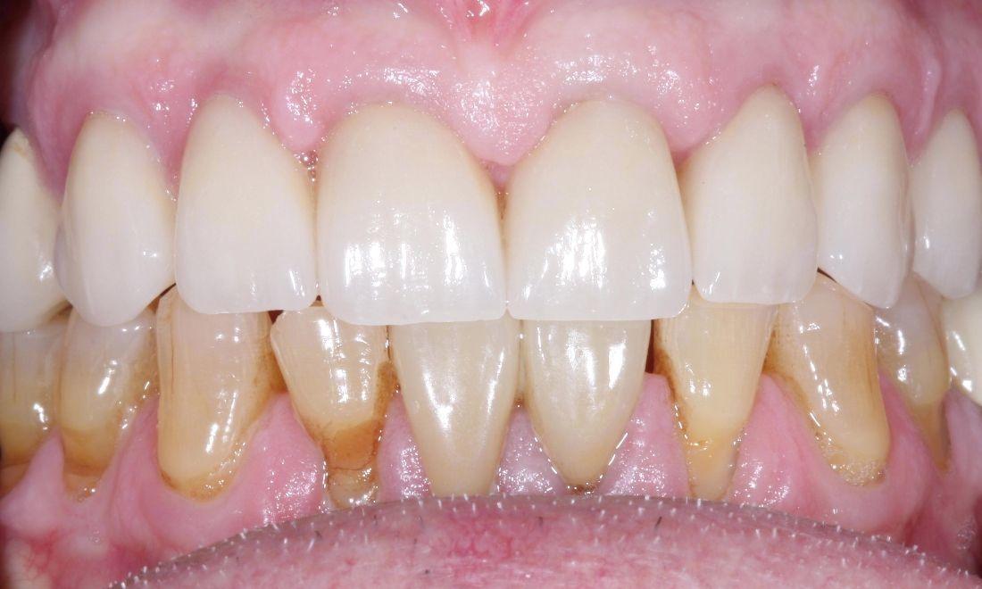 image of the same teeth after placing new dental crowns | dental crowns Moline IL