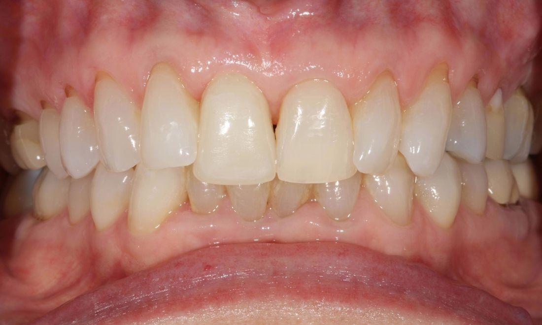 image of the same smile after a dental implant and crown | dental implants Moline IL