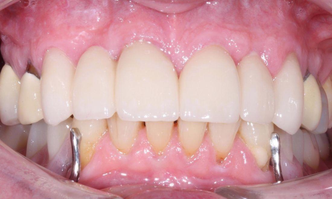 image of the same teeth following crown and bridge work | dentist Moline IL