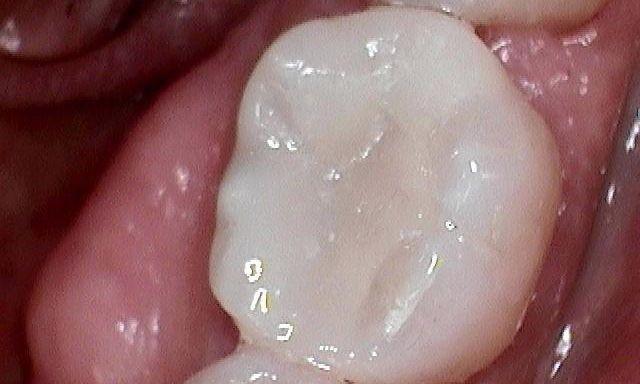 image of the same tooth after a CEREC only | dental crowns Moline IL