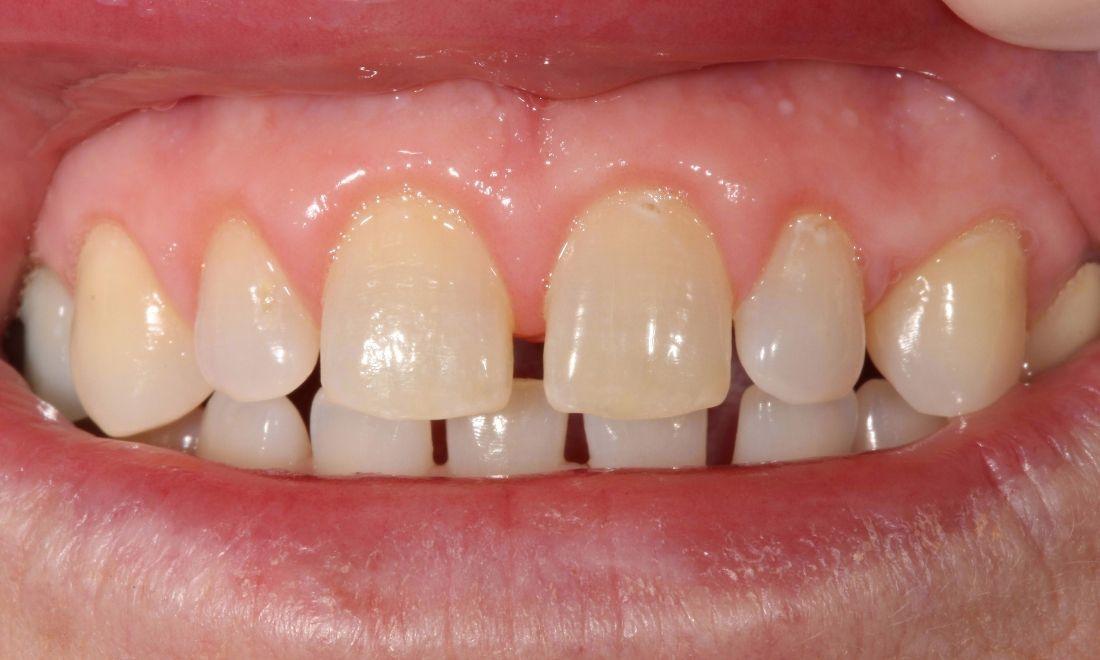 image of the same teeth after laser gum treatment | laser dentistry Moline IL