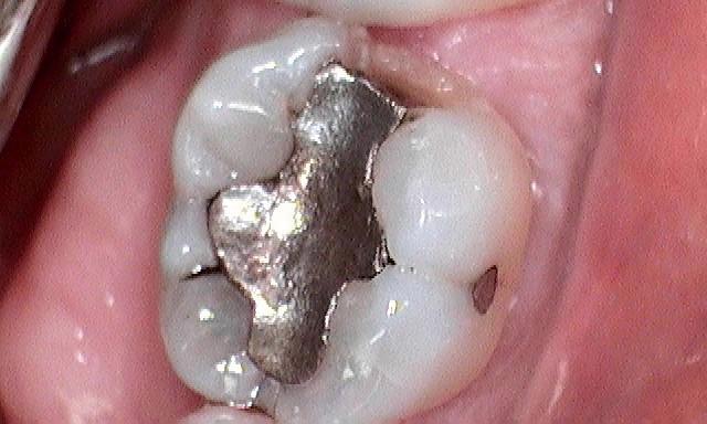 image of a tooth with an old silver filling | cerec crowns Moline IL
