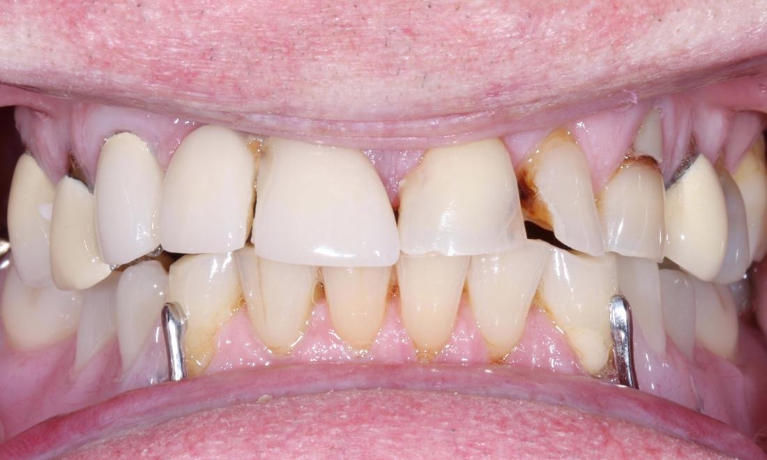 image of teeth with breaks, cavities, & bite issues | dentist Moline IL