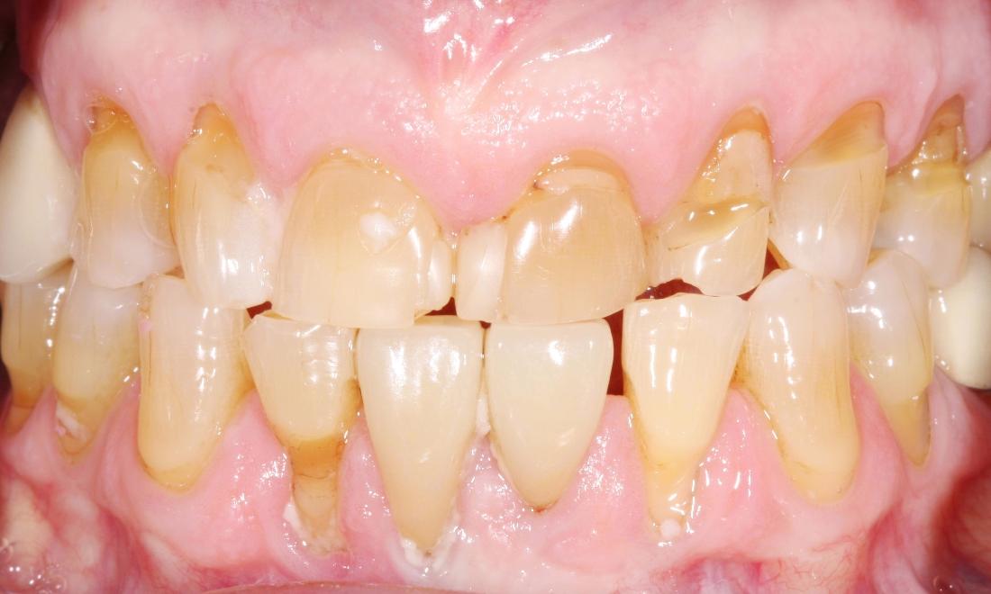 image of teeth worn and decayed from neglect | dental crowns Moline IL