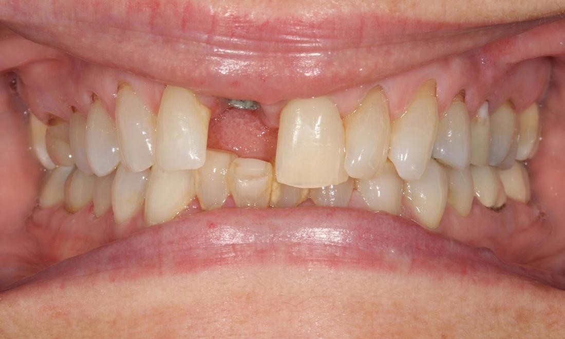 image of a smile with a missing tooth | dental implants Moline IL
