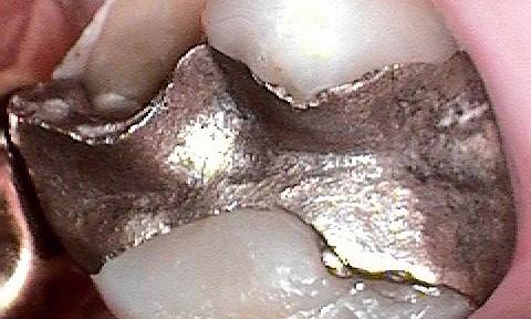 image of a tooth with a silver filling | cerec crowns Moline IL