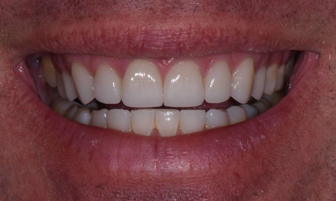 image of the same teeth following Invisalign and crowns | dentist Moline IL