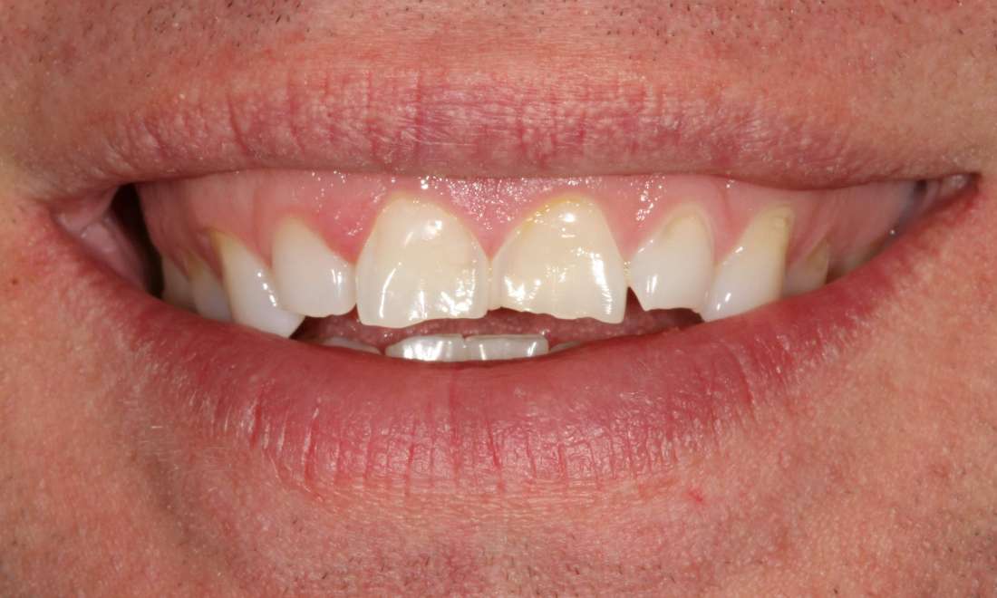 image of teeth worn and misaligned due to several years of grinding | dental crowns Moline IL