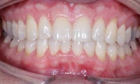 Invisalign-After-Image