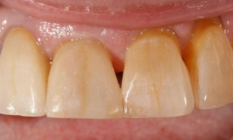 image of the same tooth after dental bonding | dentist Moline IL