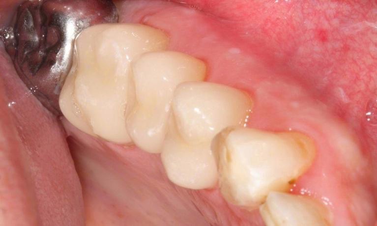 image of the same teeth following Cerec one-visit crowns | dental crowns Moline IL