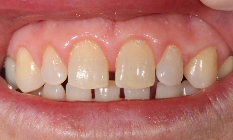 Laser-Gum-Re-contouring-After-Image