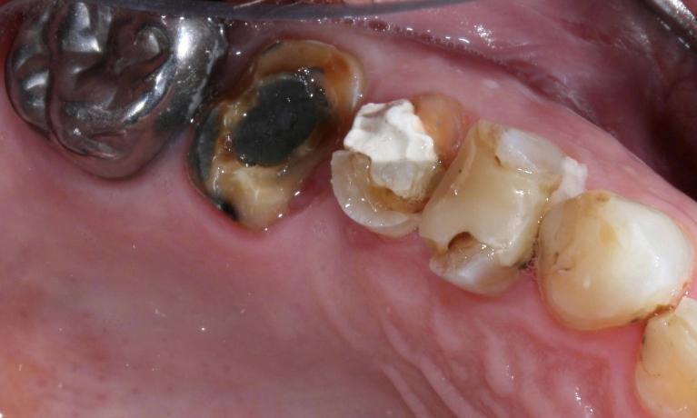 image of broken and decayed teeth | cerec crowns Moline IL