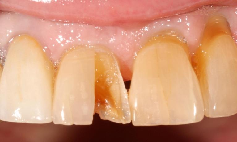 image of a tooth with a large chip | dentist Moline IL