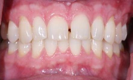 Invisalign-Before-Image