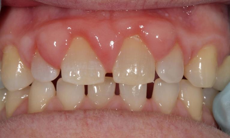 Laser-Gum-Re-contouring-Before-Image