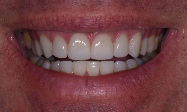 Invisalign-Crowns-for-a-Smile-Rehab-After-Image