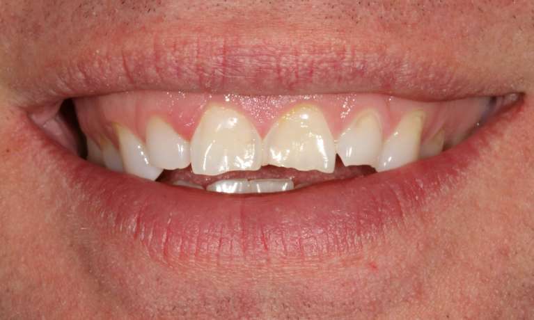 Invisalign-Crowns-for-a-Smile-Rehab-Before-Image